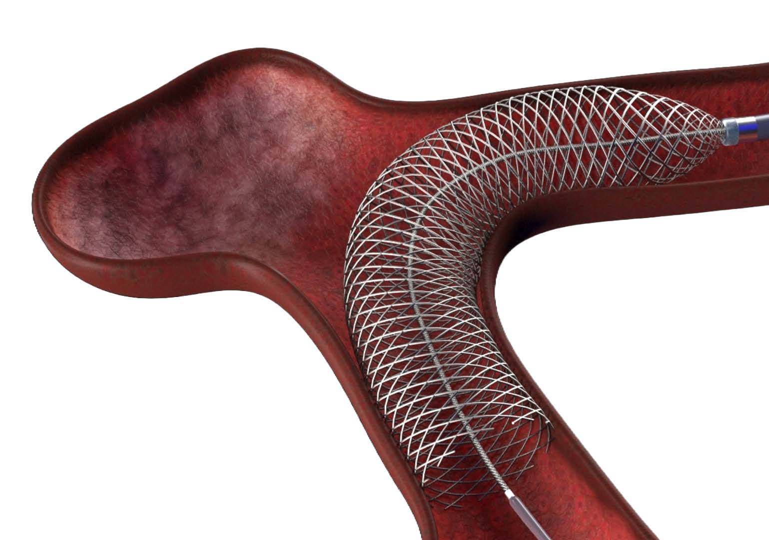 Neurovascular stent and delivery system